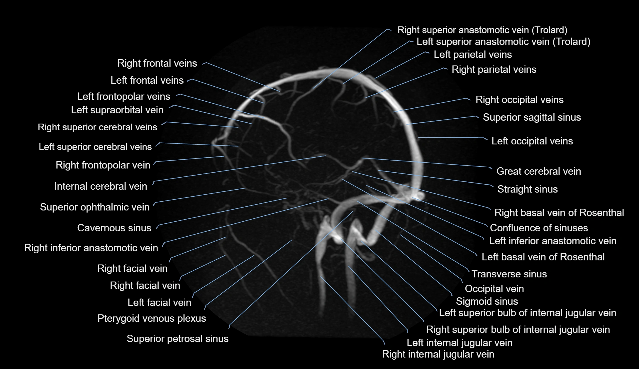 MRV brain MIP sagittal labelled anatomy 3T MRI images -img-1011001-00005.webp